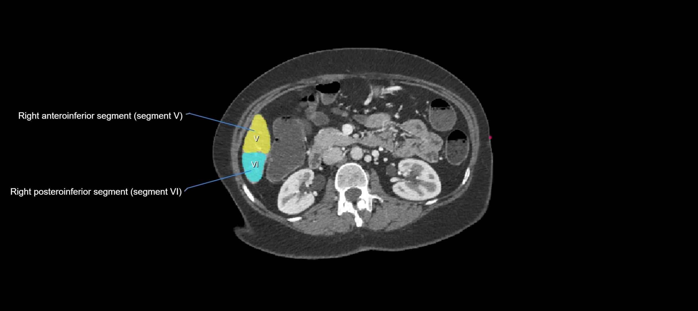 CT liver segments axial cross sectional anatomy labelled image-00017.webp